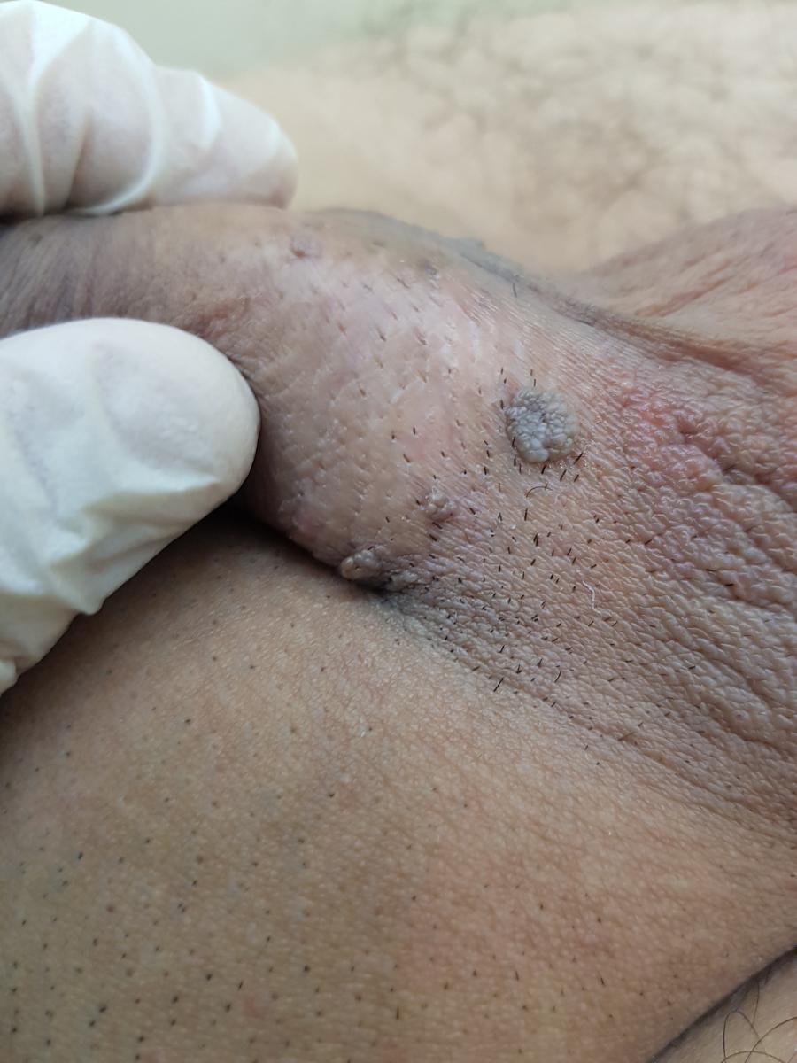 признаки ВПЧ 18 у мужчин