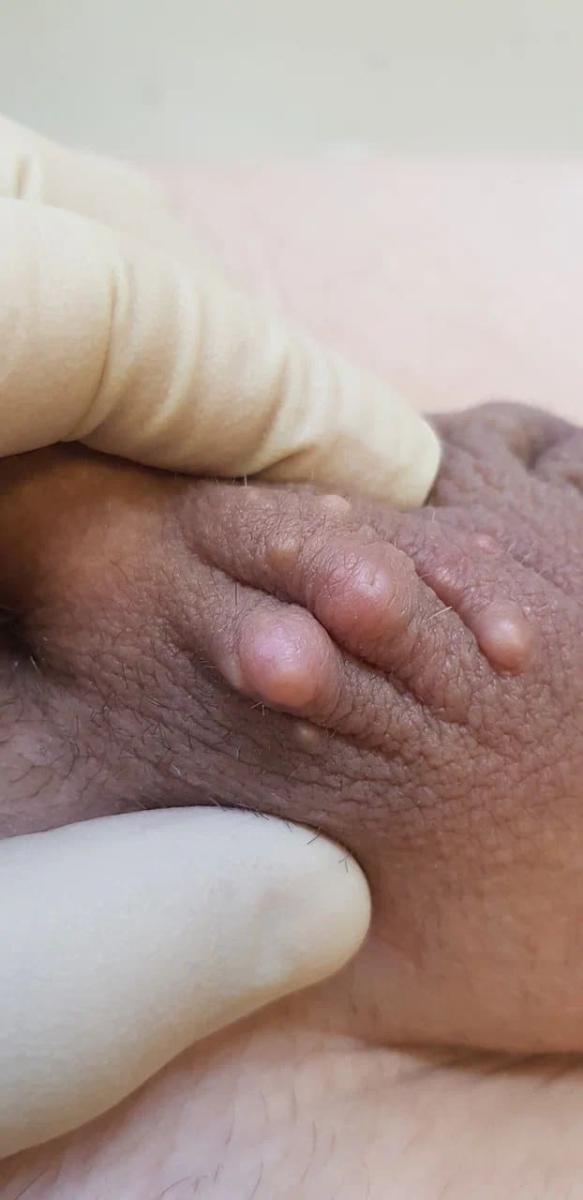 атерома строение атеромы