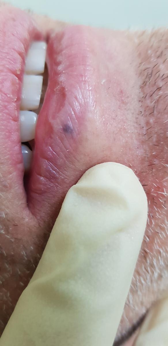 гемангиома