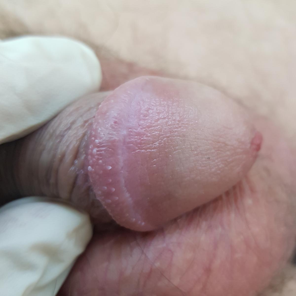 следы от укуса после лечения следы от укуса на члене после лечения