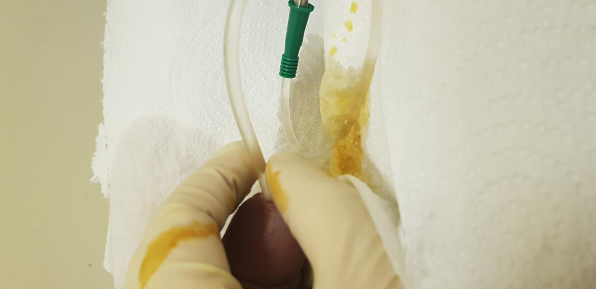 инстилляция