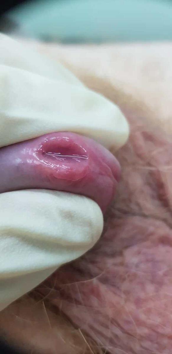 уретрит уретрит