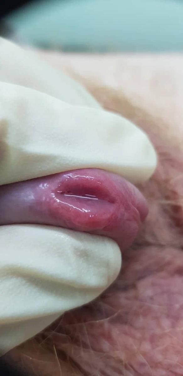 уретрит бактериальный