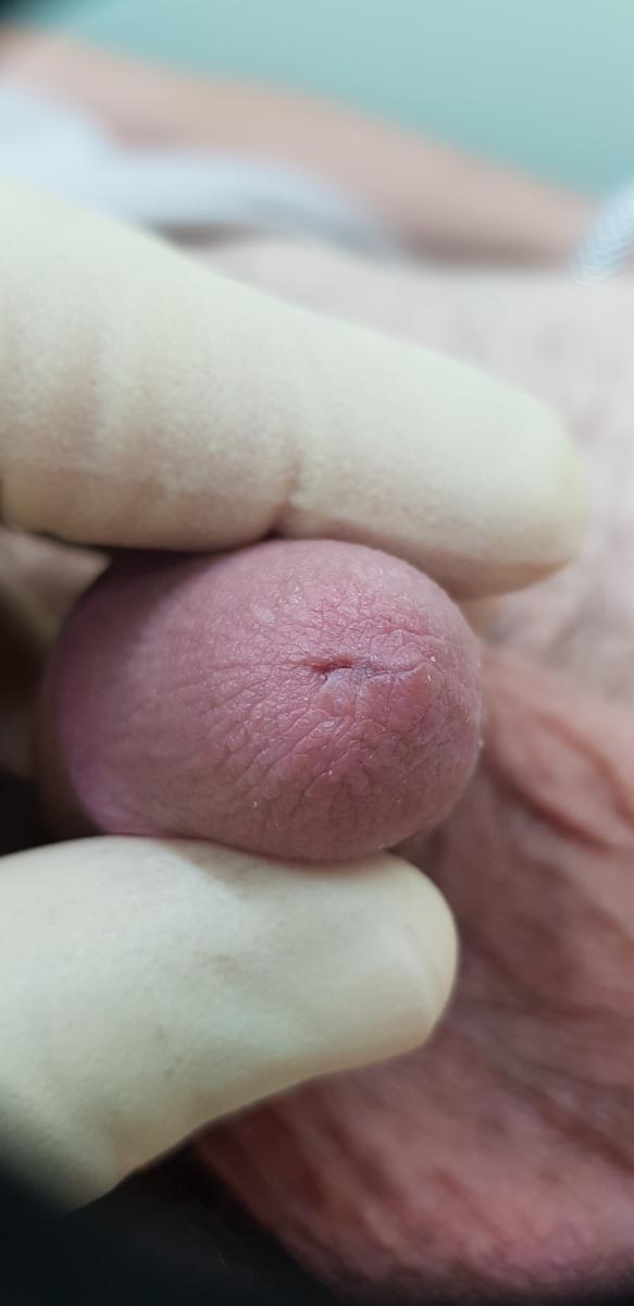 симптомы уретропростатита