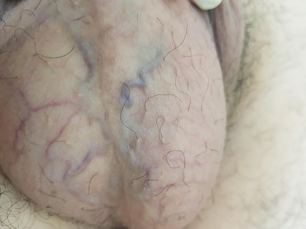 Вены на мошонке Вены на мошонке