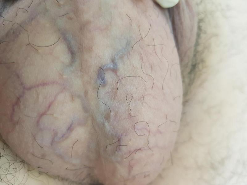 вены на мошонке