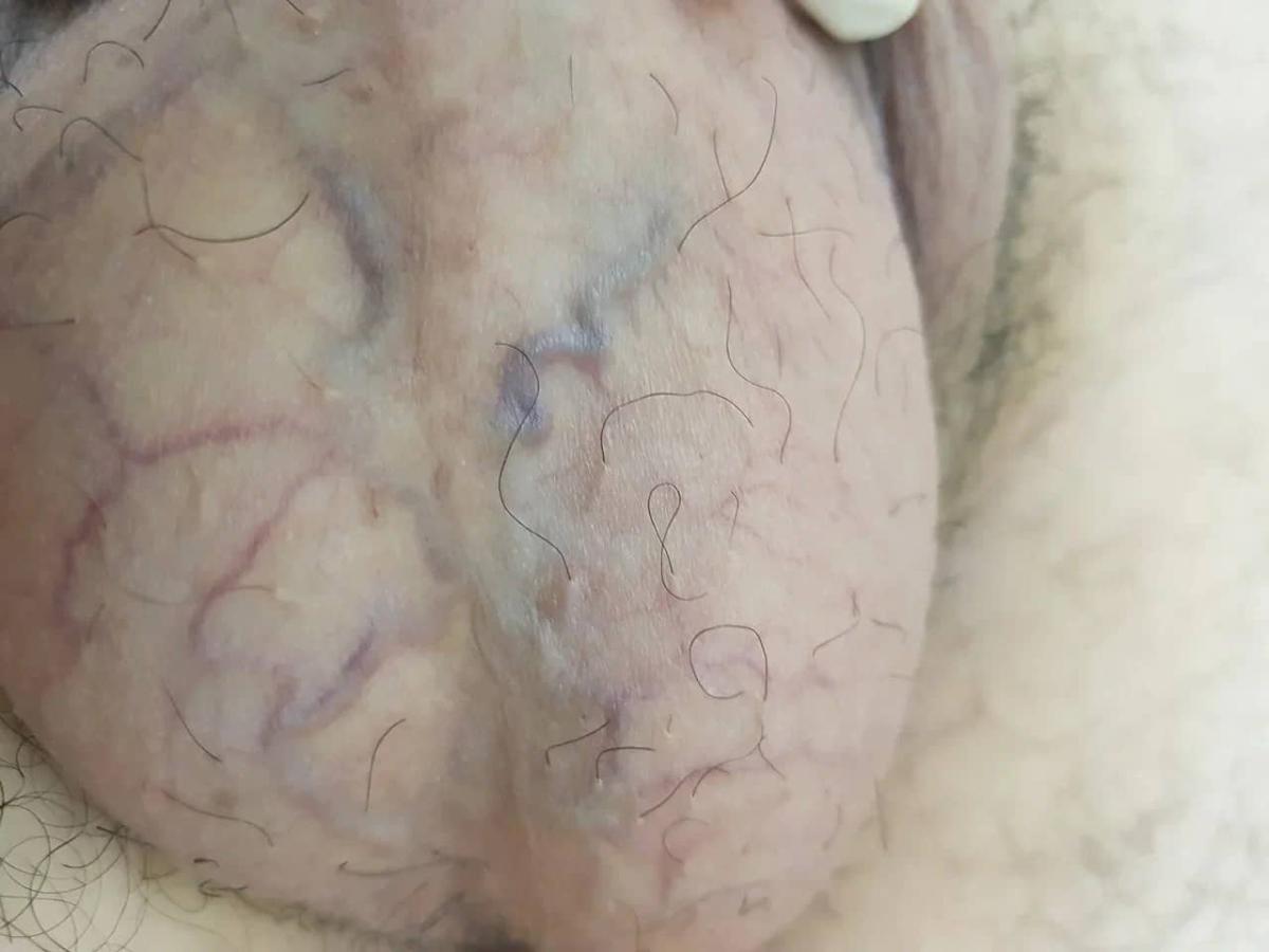 вены на мошонке