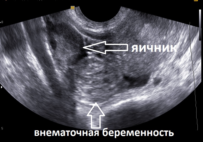 внематочная беременность на УЗИ