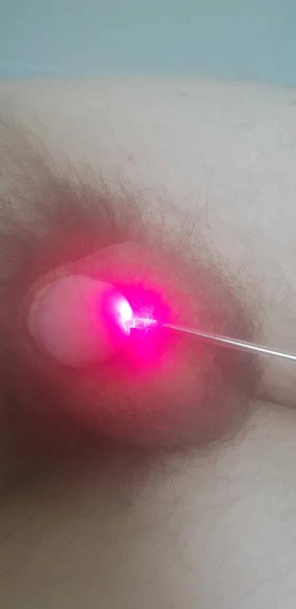 Внутри уретральная фотодинамическая лазерная терапия