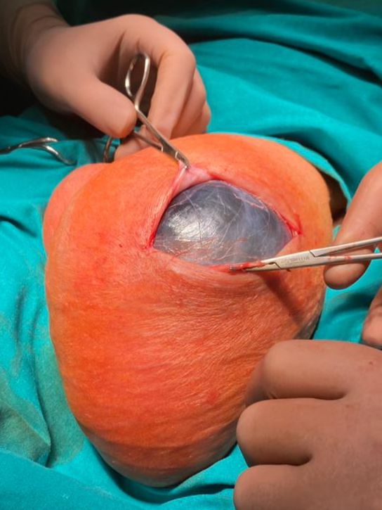 Жидкость в мошонке - операция Жидкость в мошонке