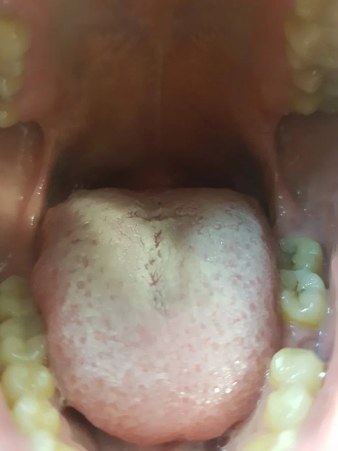 фото воспаление горла и налет на языке при гарднерелле
