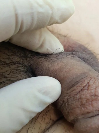 фото воспаление сосуда в основании члена