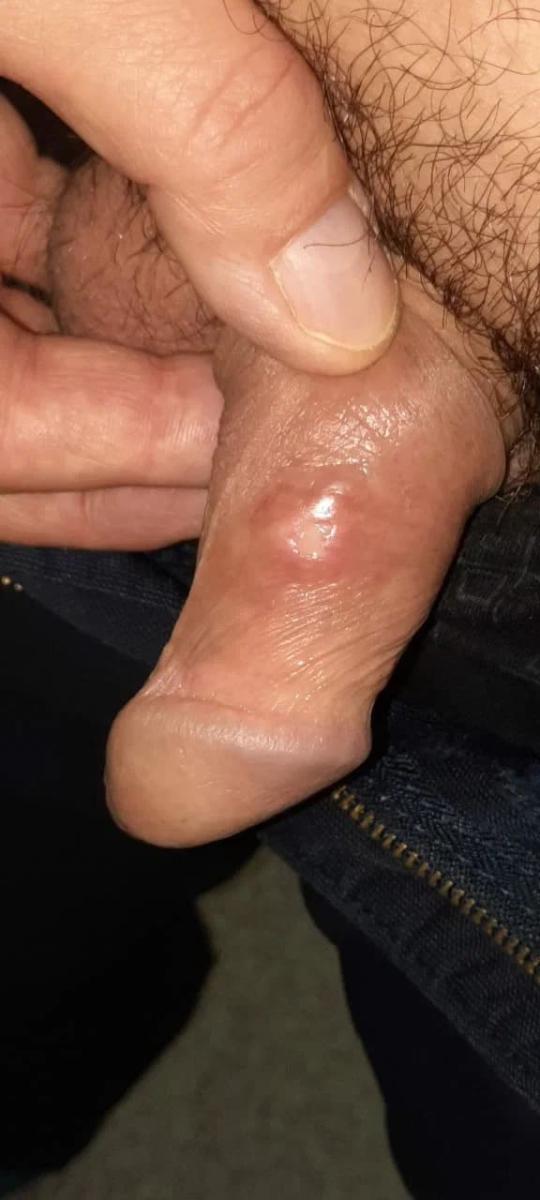 Фурункул в паху