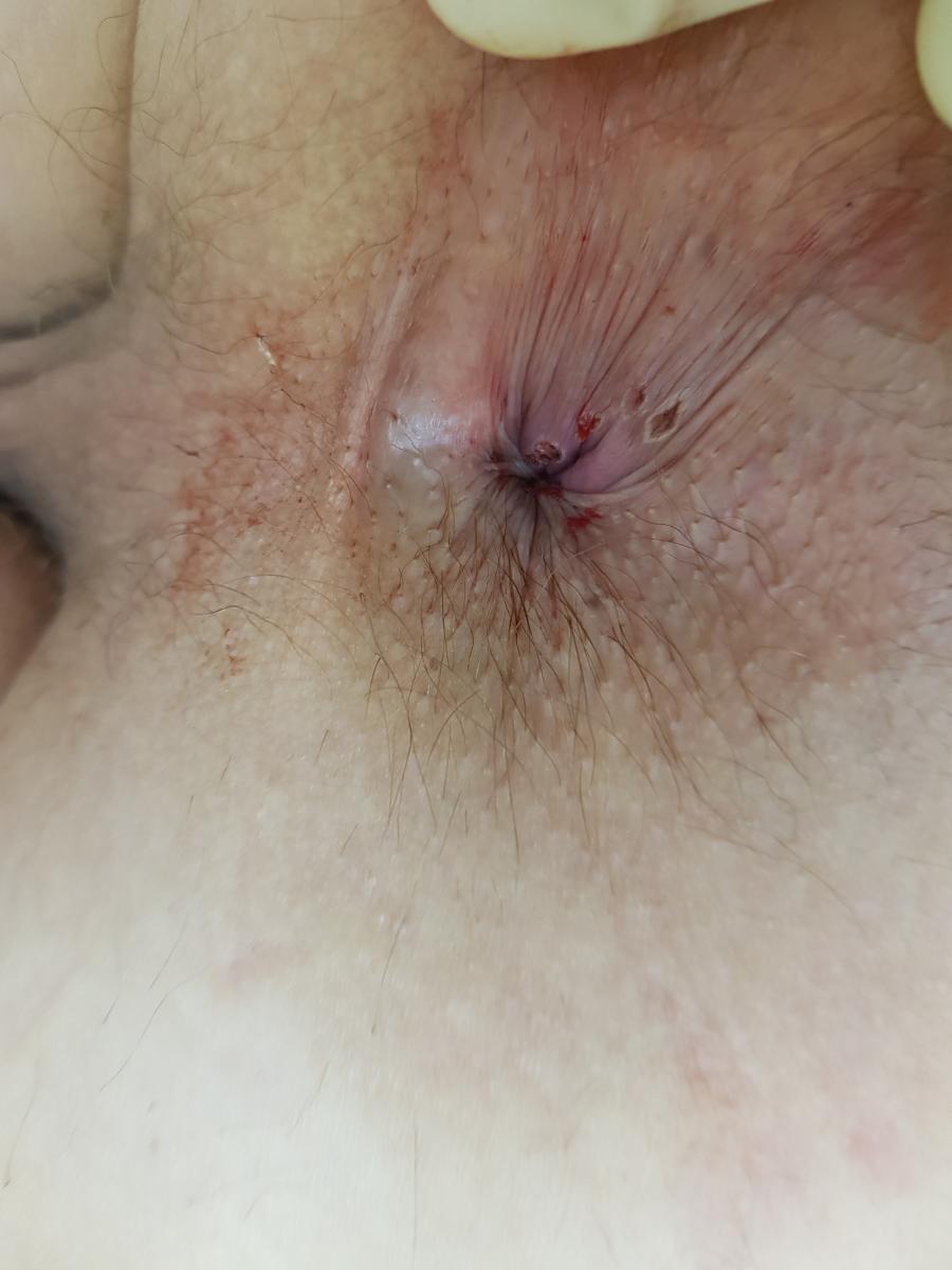 после удаления после