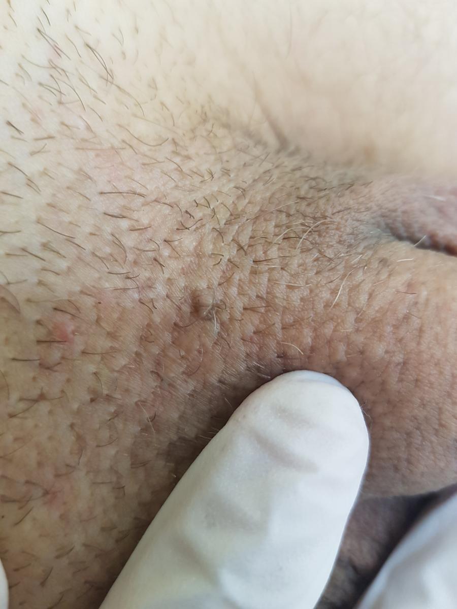 кондилома до удаления пример 1 до