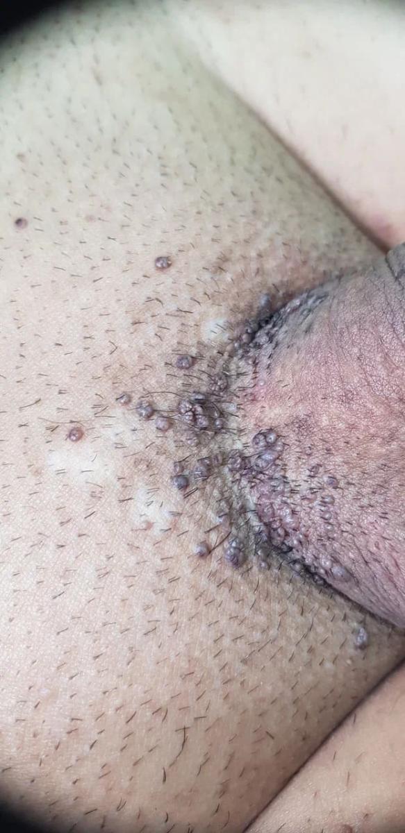 типы ВПЧ типы вируса папилломы впч