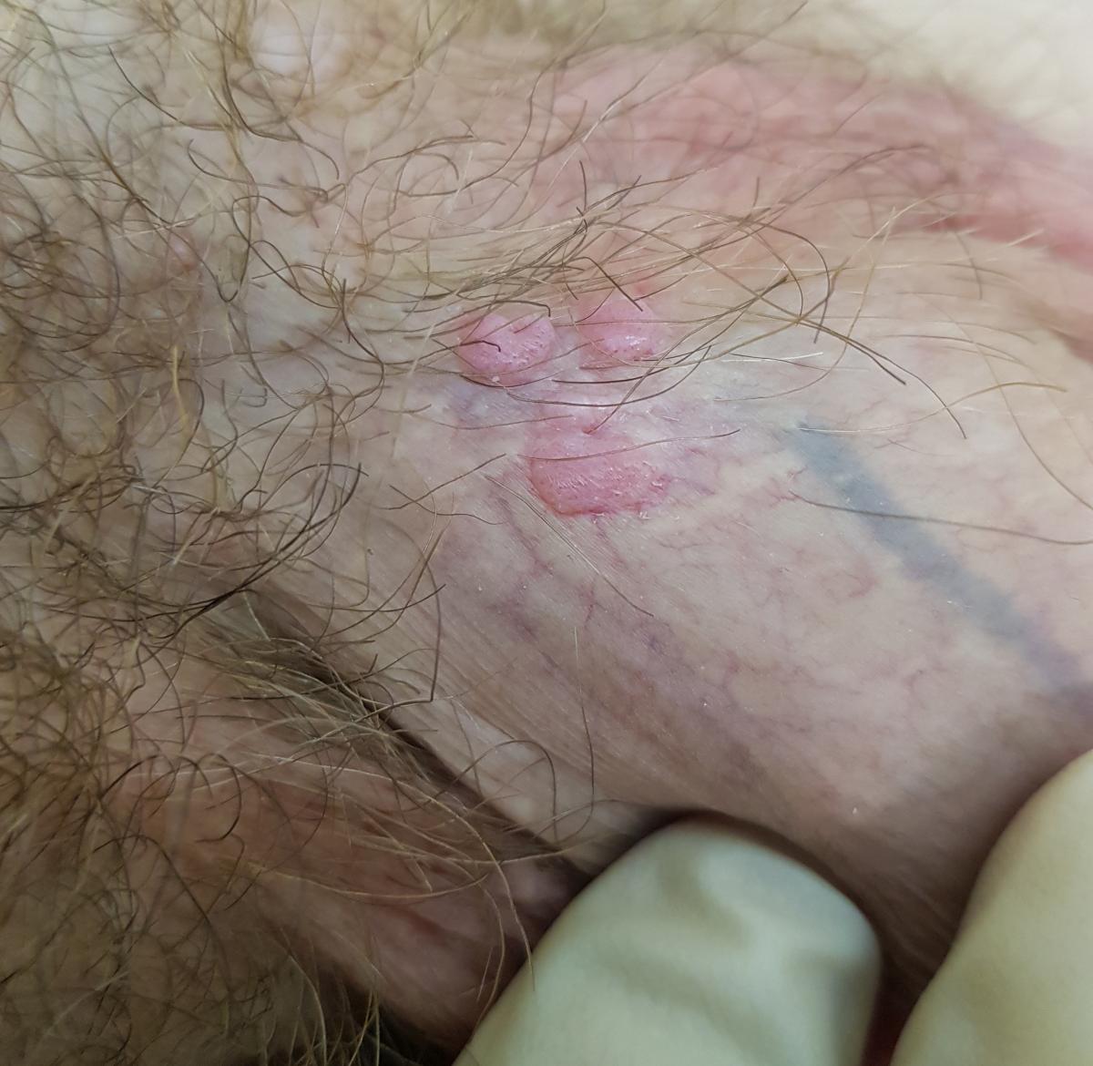 симтомы ВПЧ