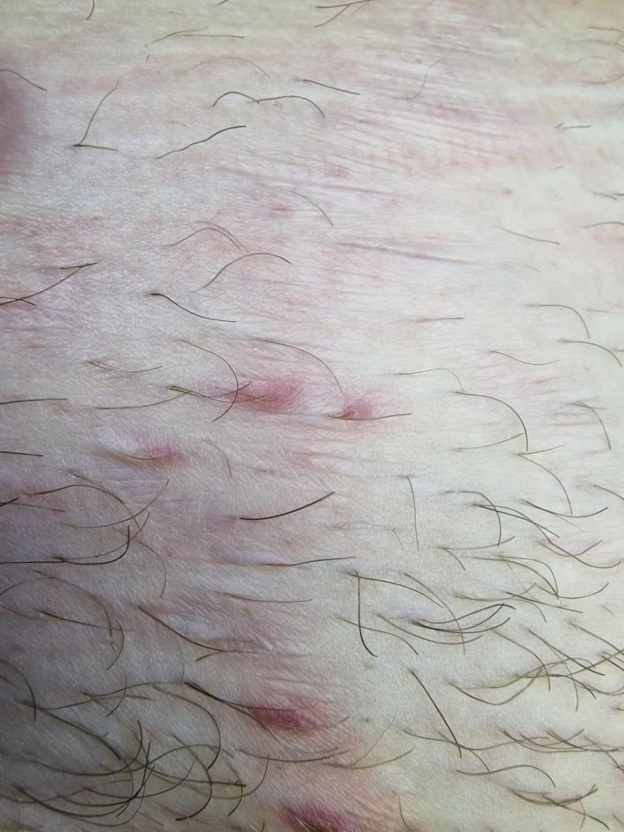 Вросшие волосы