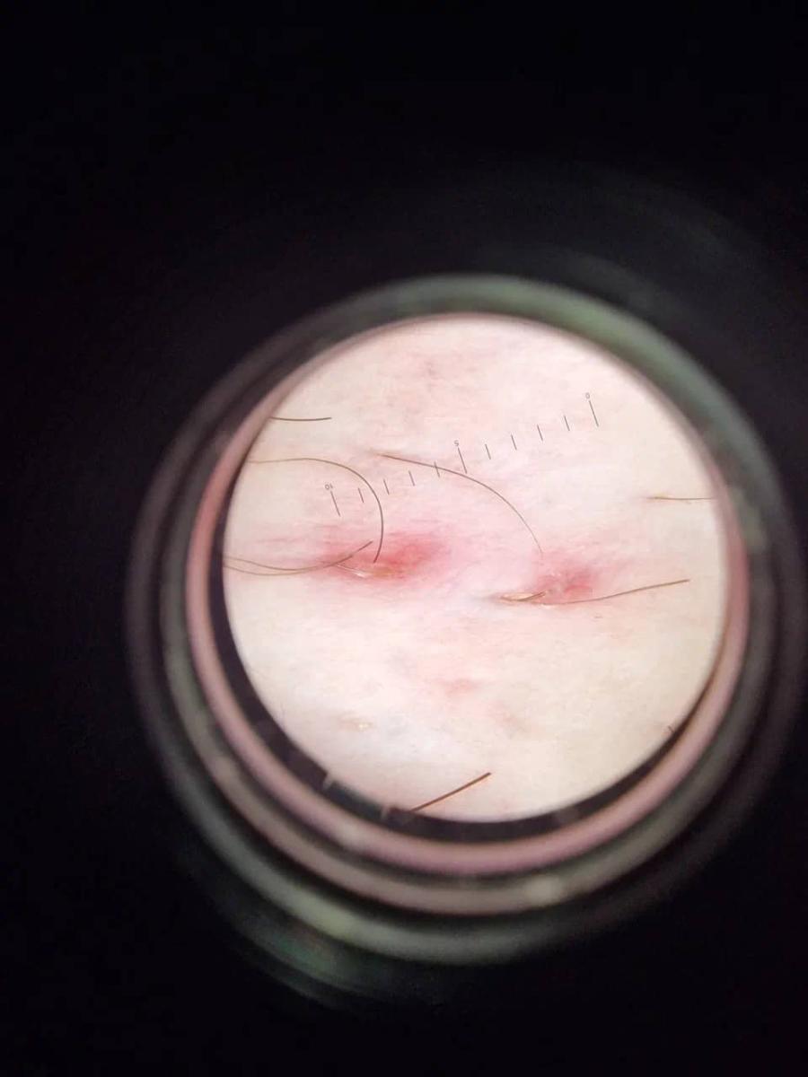 Вросшие волосы