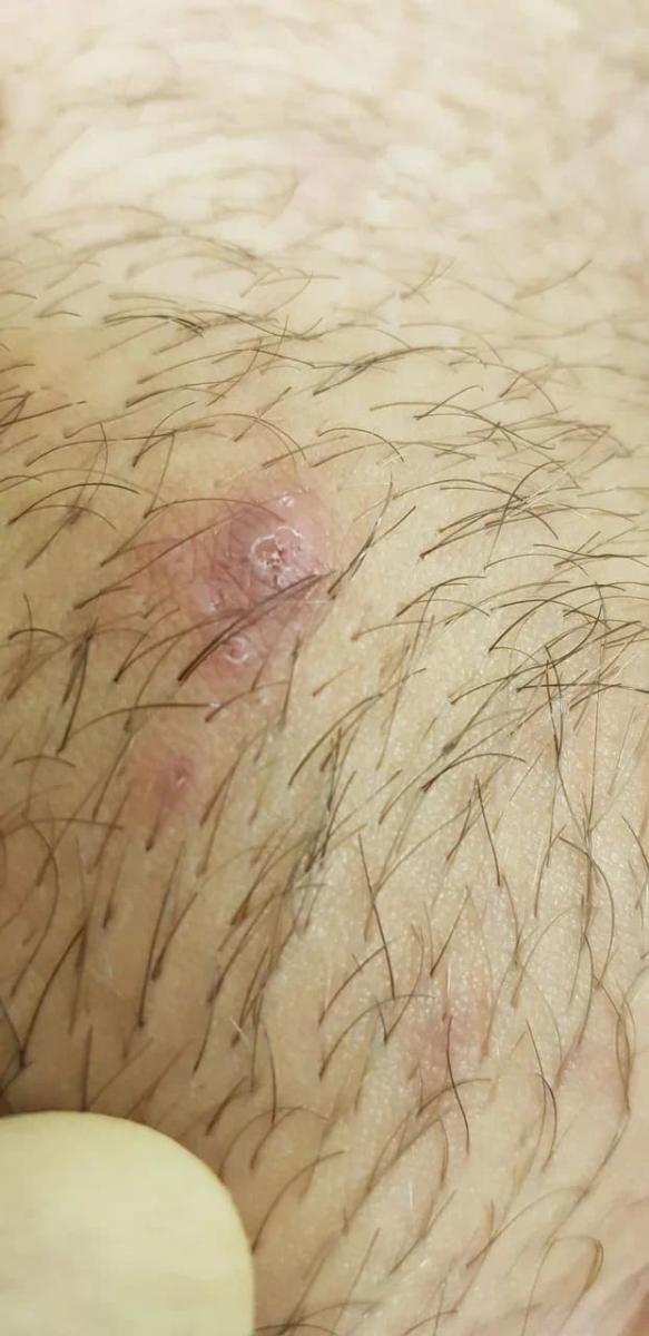 Вросшие волосы