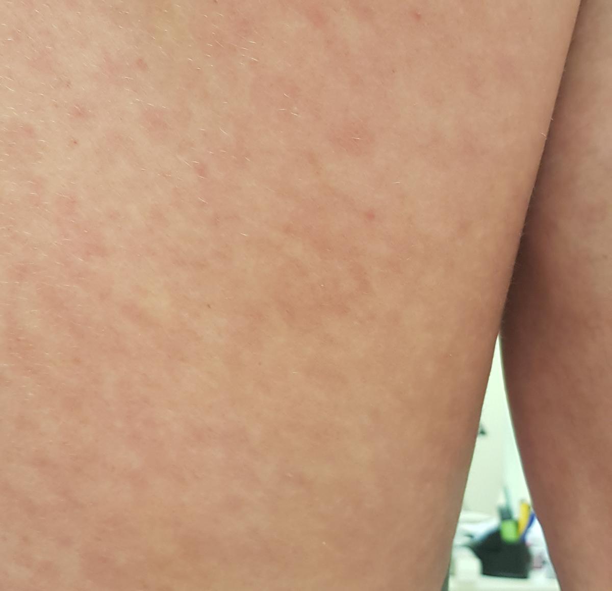 сыпь на теле