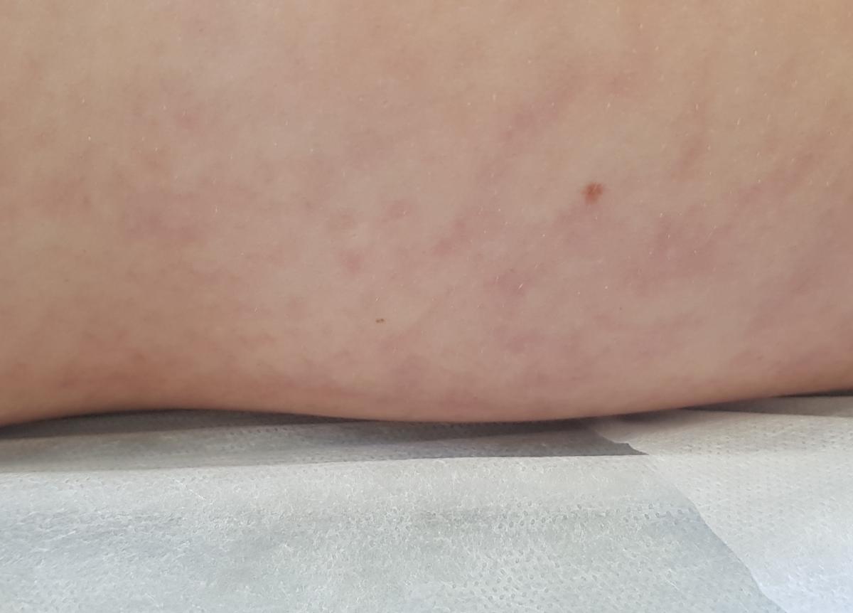 сыпь на теле