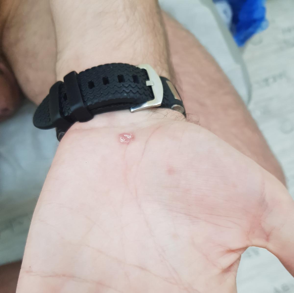 симтомы сифилиса на руке