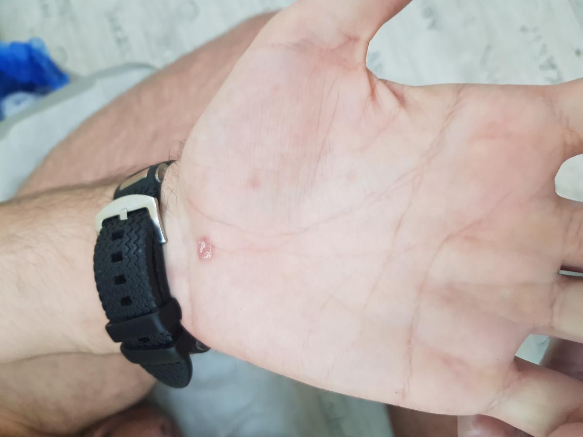 воротничок БИЕТТА при вторичном сифилисе Вокруг папул могут скапливаться чешуйки