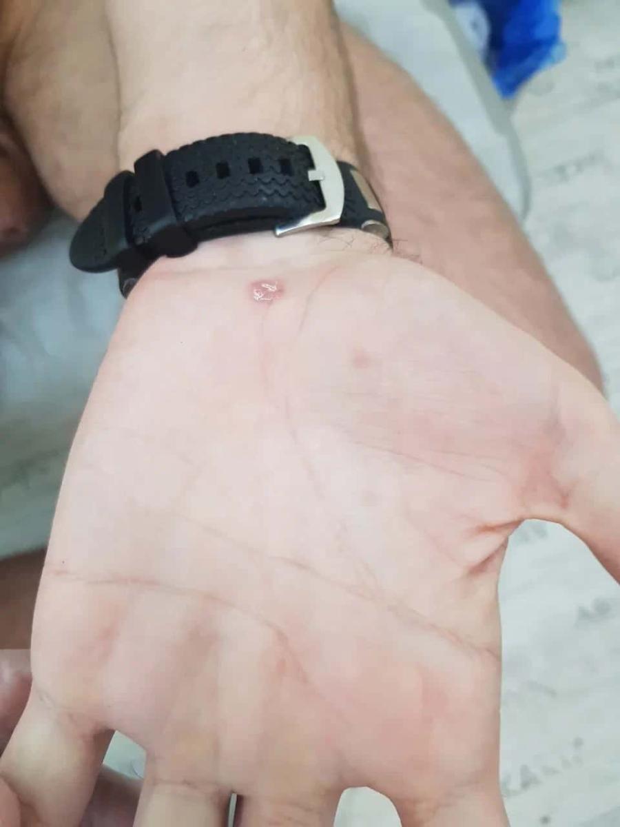 вторичный сифилид