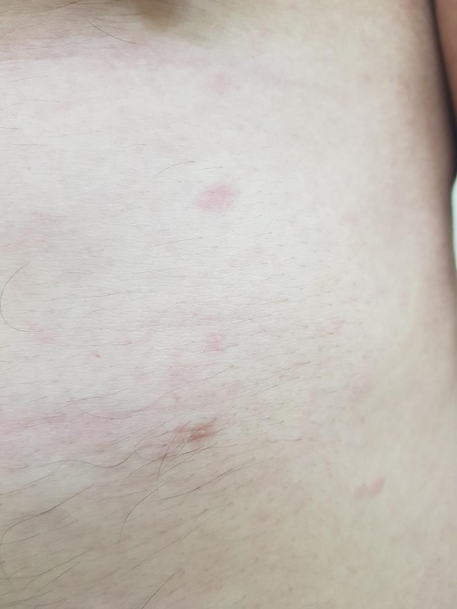 скрытый сифилис диагноз: сифилис