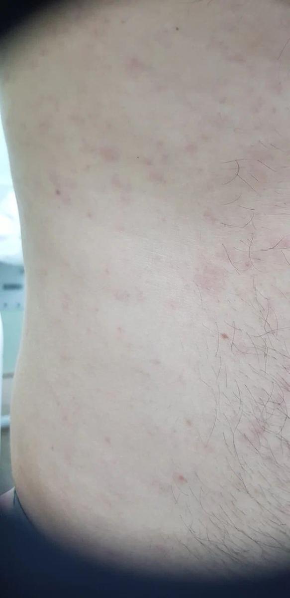 вторичный сифилис