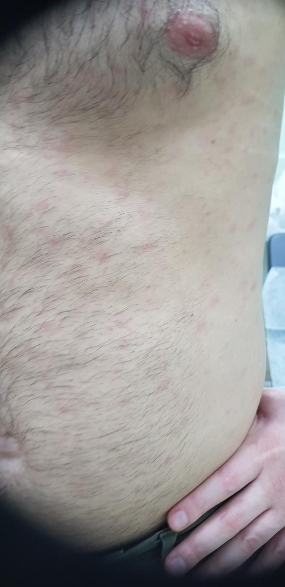 лечение антибиотиками пенициллиновой группы