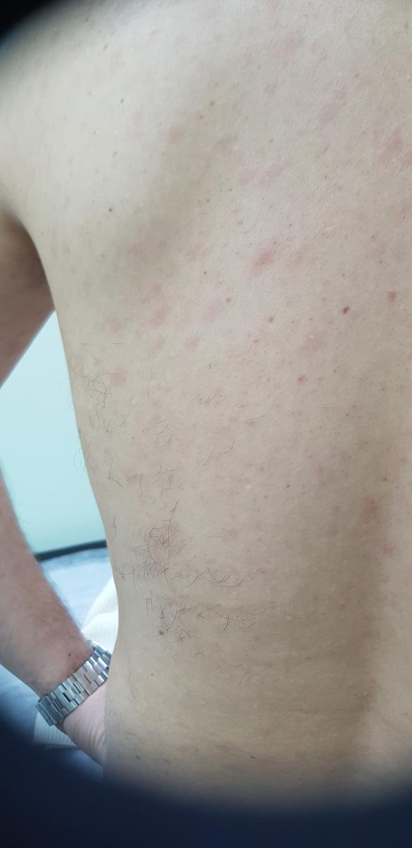 Признаки вторичного сифилиса