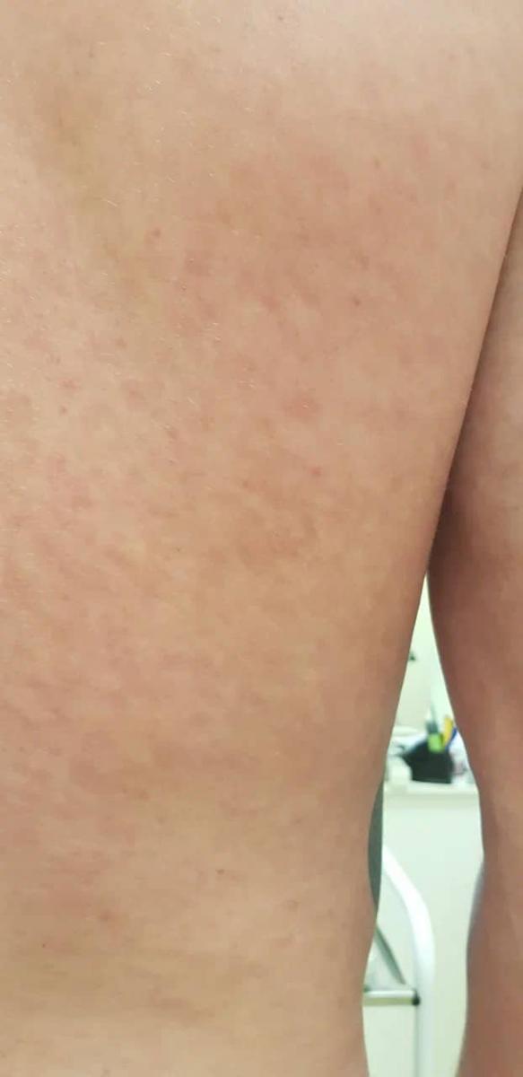 симптомы сифилиса