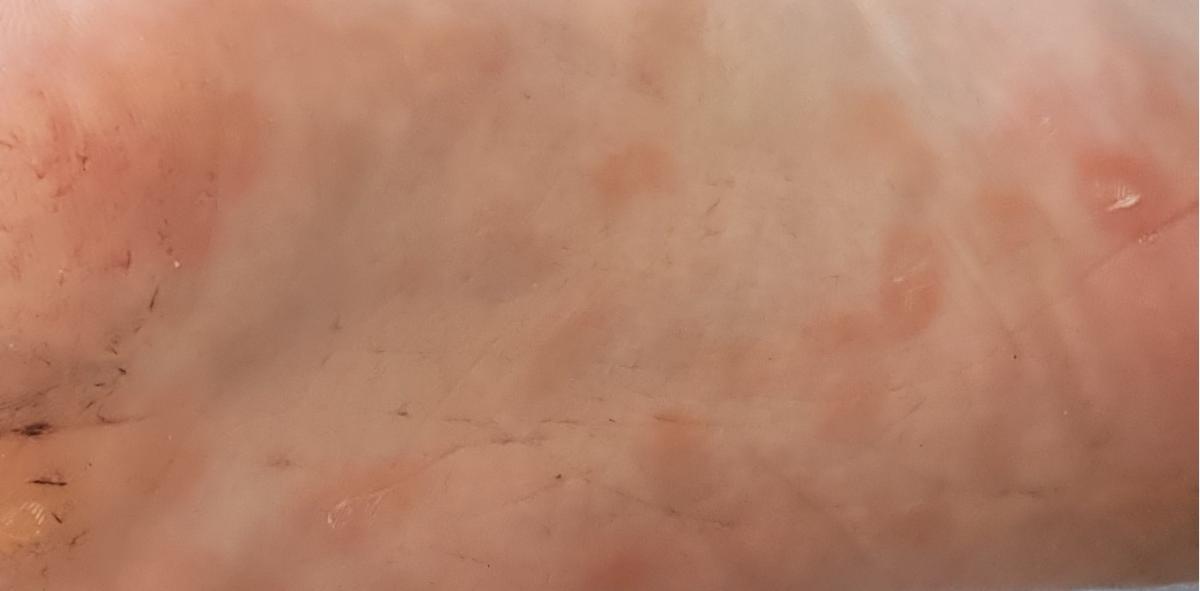 Сифилитические пятна на стопах СИФИЛИС