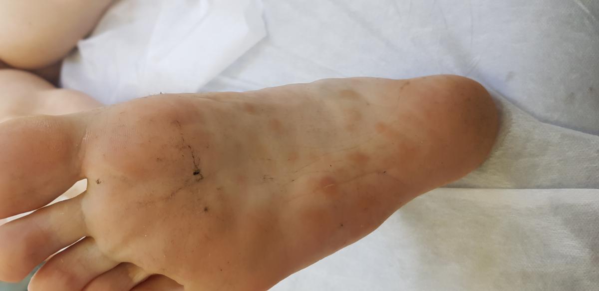 Сифилитические пятна на стопах СИФИЛИС