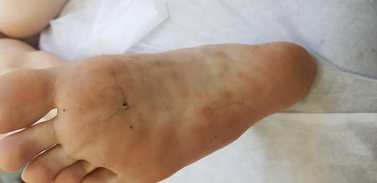 Сифилитические пятна на стопах СИФИЛИС