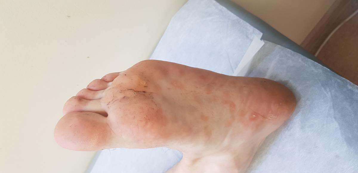 Сифилитические пятна на стопах СИФИЛИС