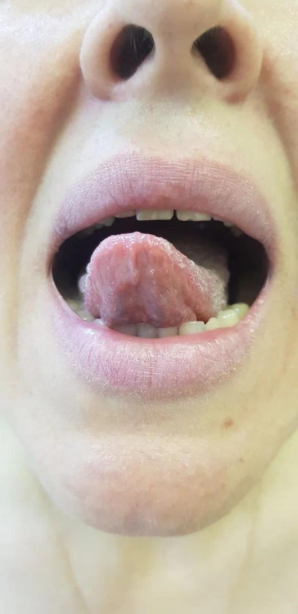 вторичный сифилис с шанкром во рту