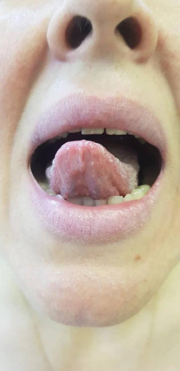 Сифилиды во рту Шанкр на языке