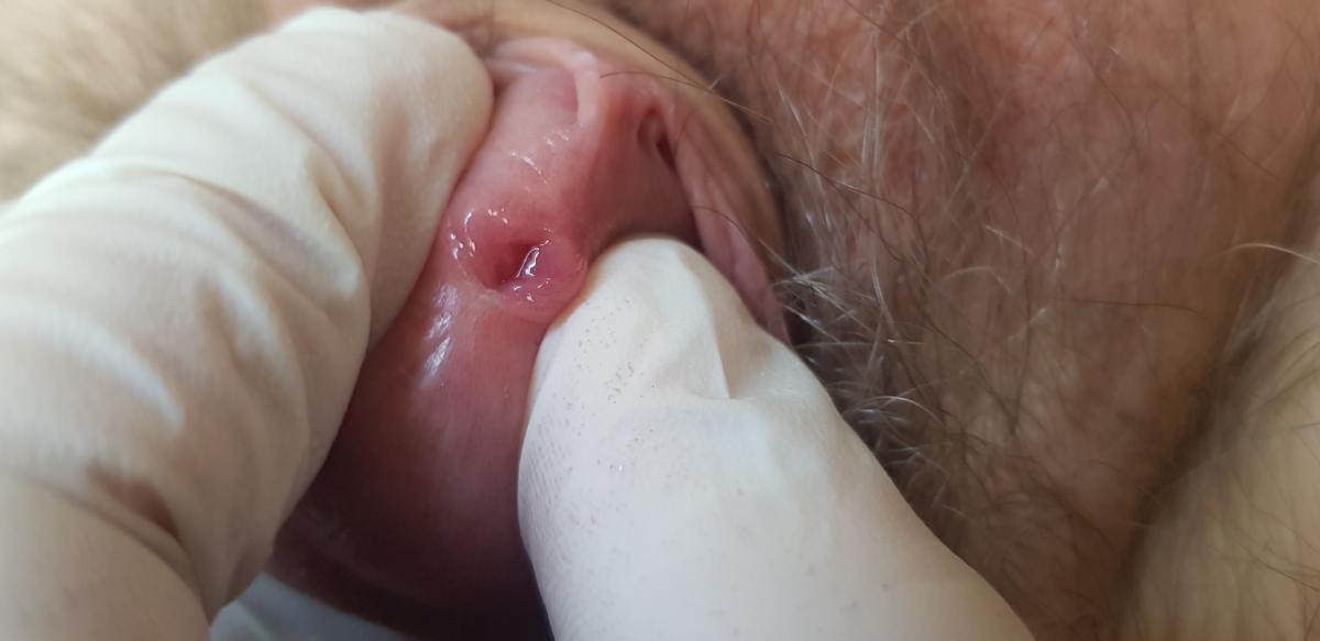 секс при уреаплазмозе