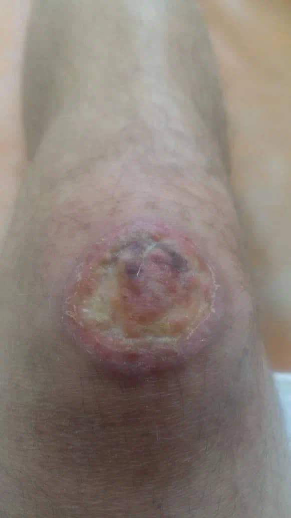 поражение суставов