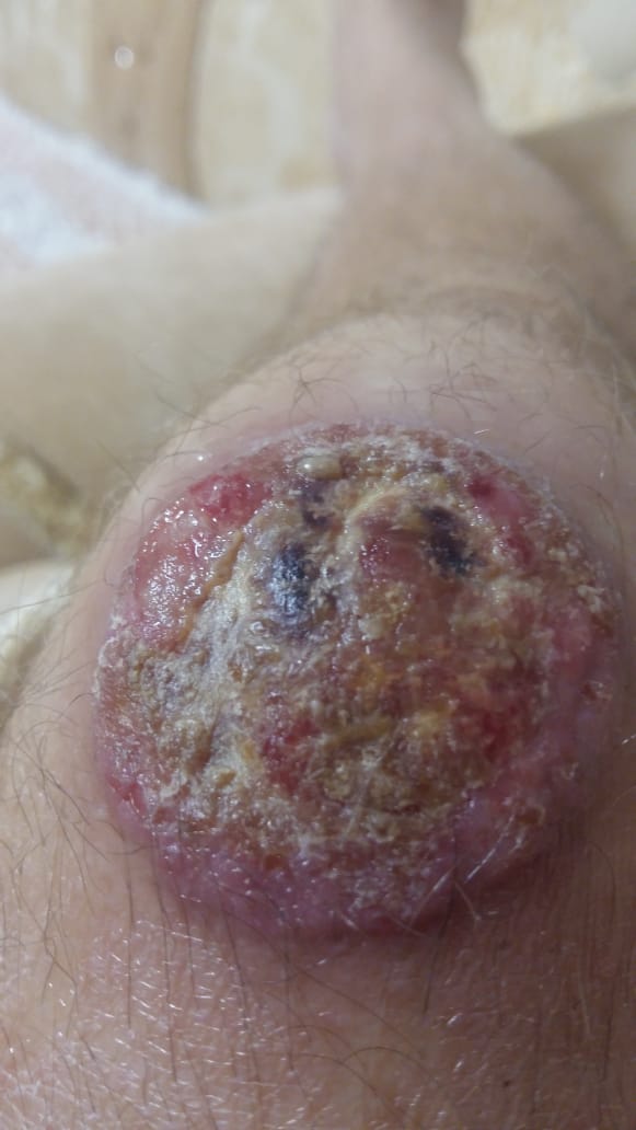 гонококковая инфекция