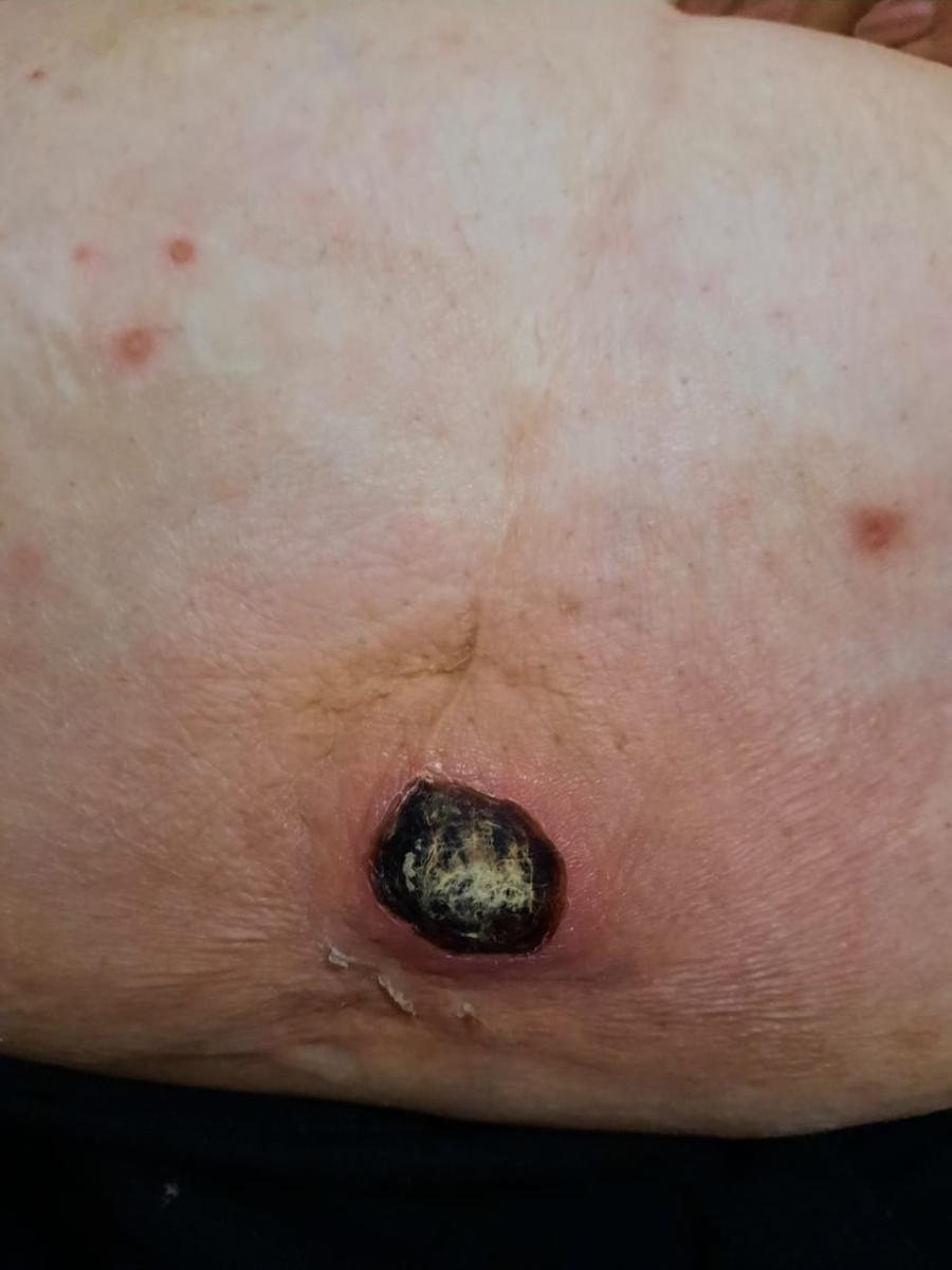 Гуммы при третичном сифилисе