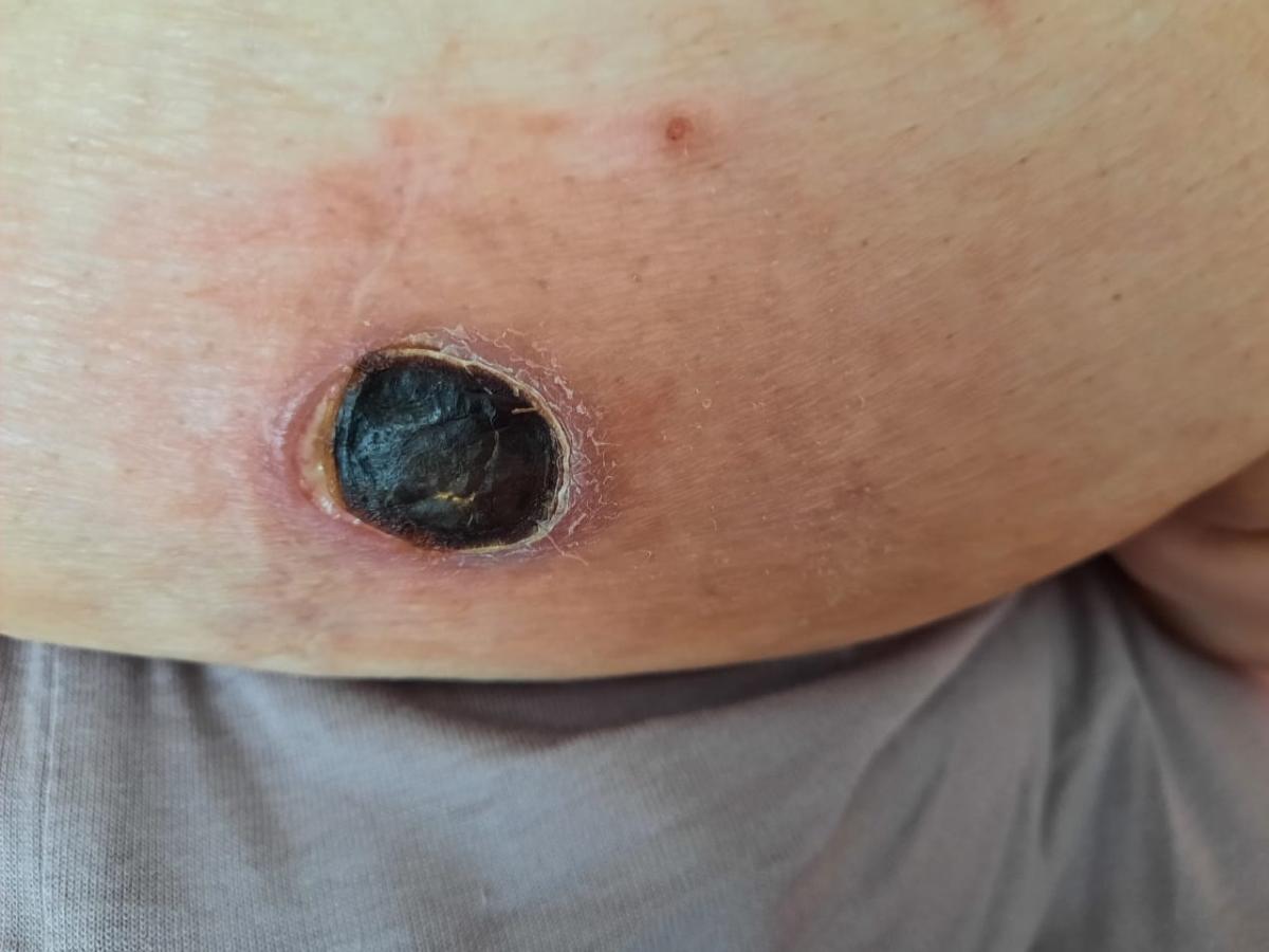 гнойники при сифилисе