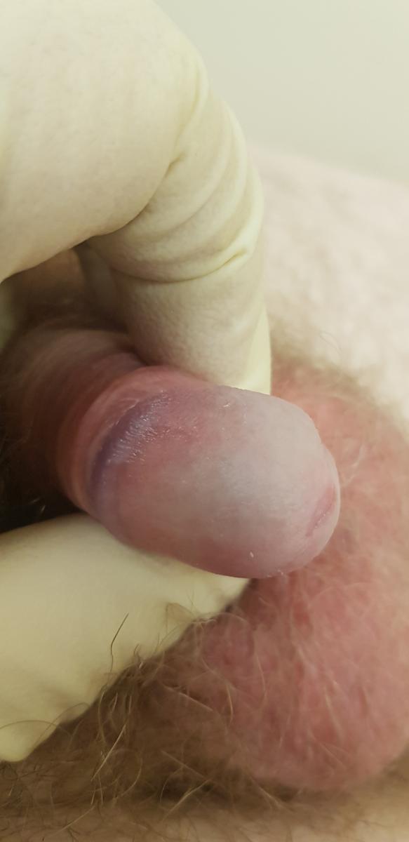 Покраснение головки члена