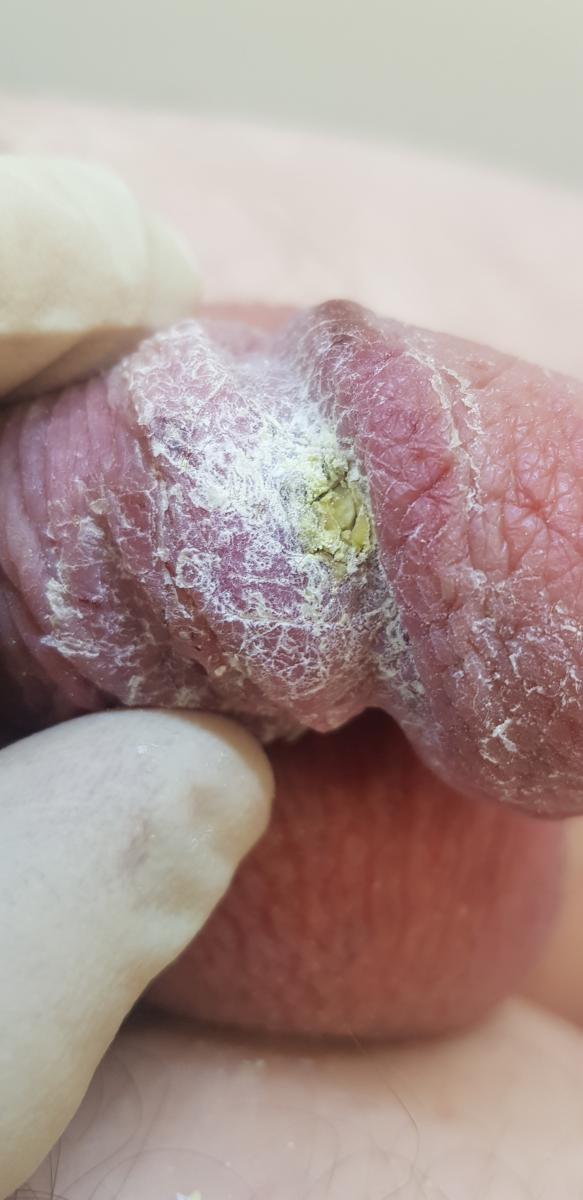 Результаты лечения ожога члена