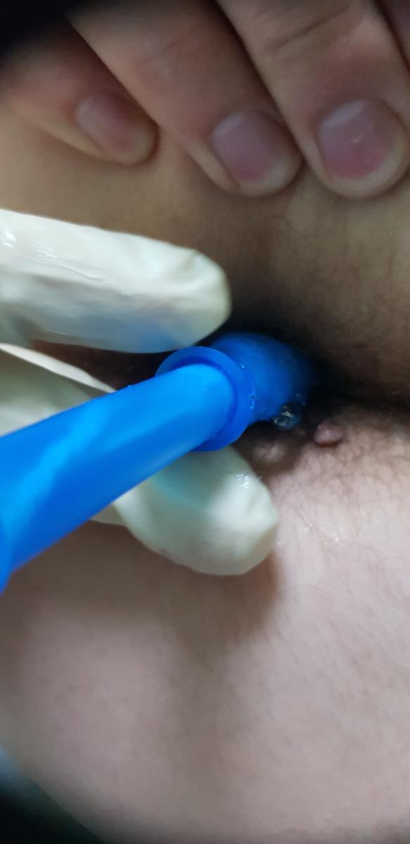 электрофорез в анус в терапии простатита электрофорез