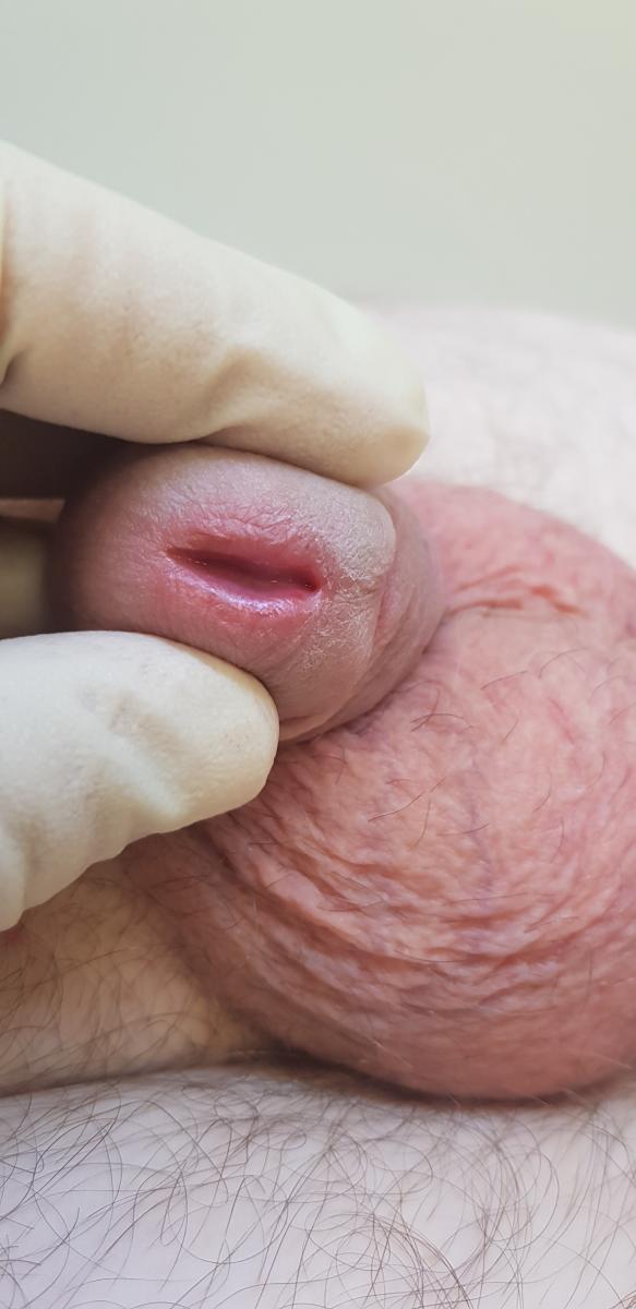 Хронический хламидийный простатит простатит