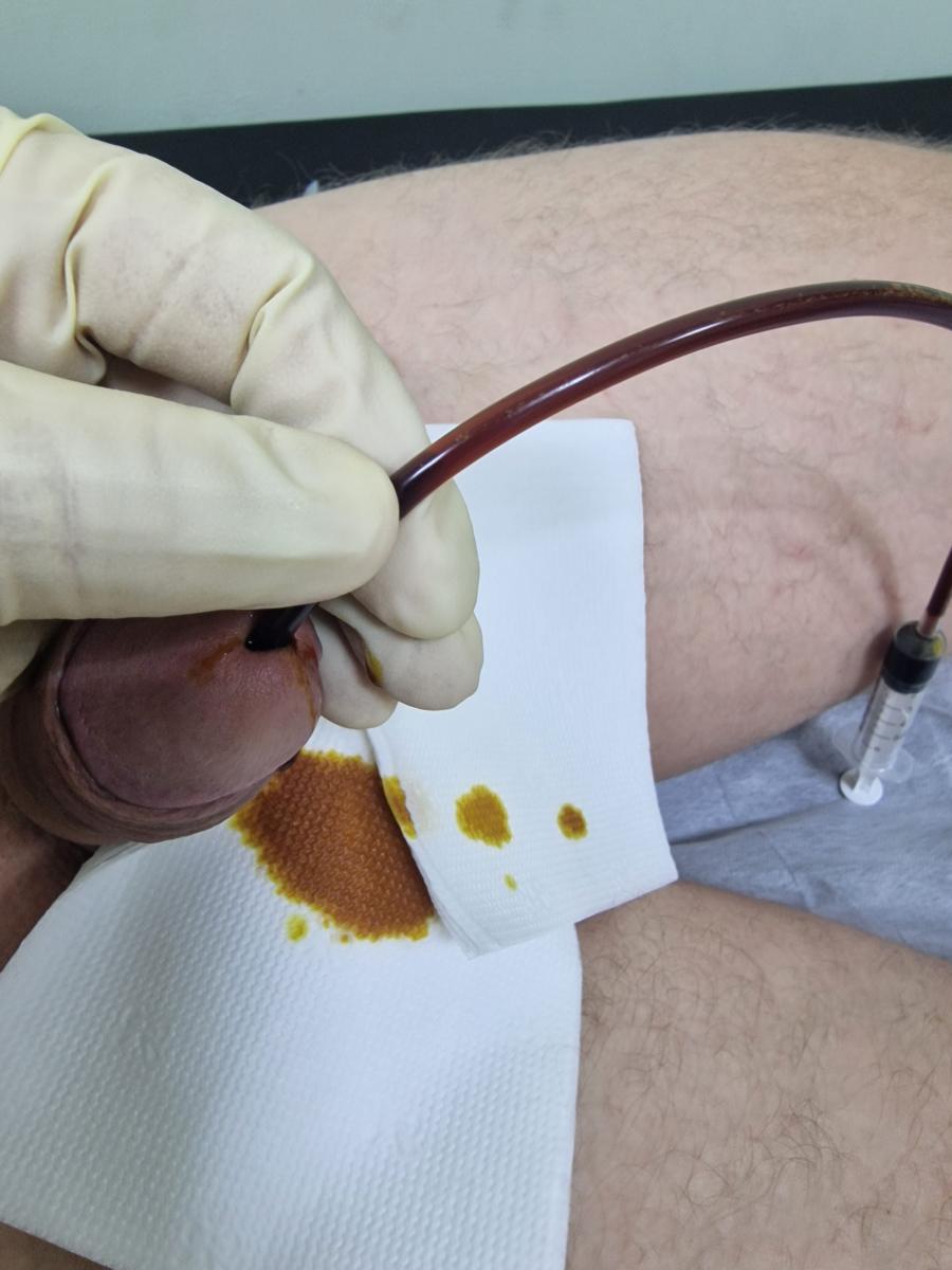 нстилляция в уретру при простатите инстилляция